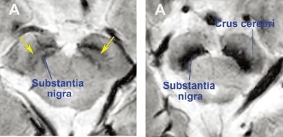 그림입니다.

원본 그림의 이름: [사진] 정상 뇌 흑질(좌), 파킨슨 환자의 뇌 흑질(우).jpg

원본 그림의 크기: 가로 819pixel, 세로 398pixel