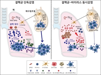 그림2) 결핵균-바이러스 동시감염에 의한 중증결핵 발생 기전